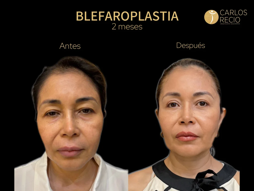 Lifting de cejas: cuándo las cejas caídas envejecen más que las arrugas Dr Recio